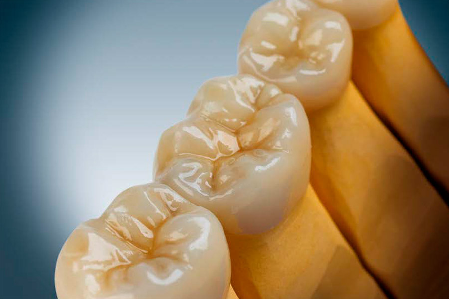 Z Crown Dental Layered Zirconia Ceramil® Image